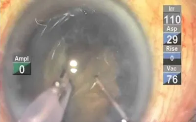 Adult Cataract Surgery