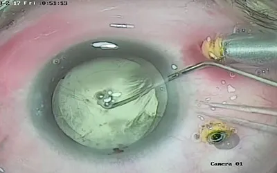 Adult Cataract Surgery