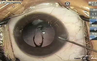 Pediatric Eye Trauma Repair