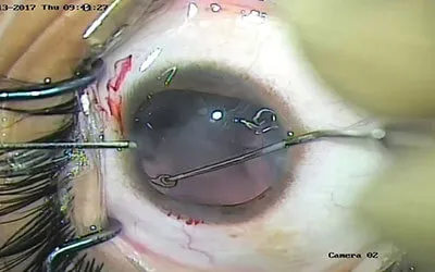 Pediatric Eye Trauma Repair