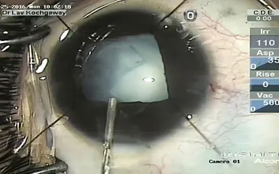 Pediatric Cataract Surgery