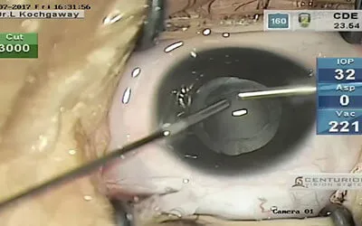 Pediatric Cataract Surgery