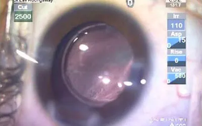 Pediatric Cataract Surgery